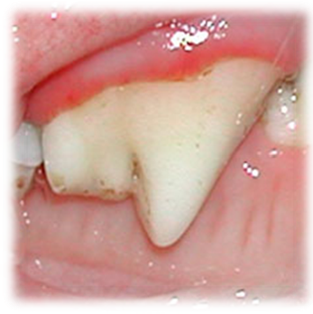 gingivitis